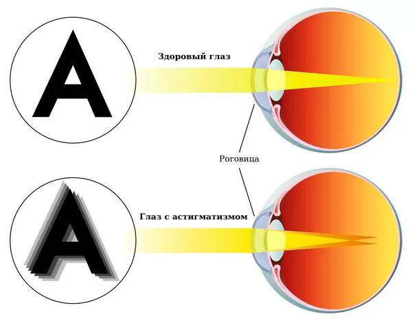 Астигматизм