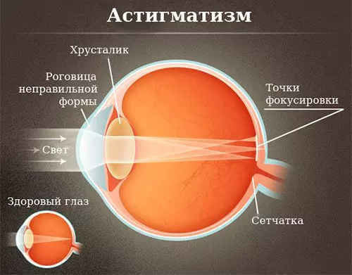 Астигматизм
